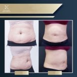 Before and after liposuction results at Asia Cosmetic Hospital, visible abdominal contouring