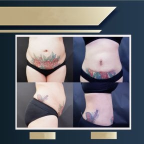Before and after liposuction results at Asia Cosmetic Hospital, visible abdominal contouring