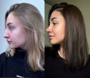 Resultados de rinoplastia antes y después en Büyük Anadolu Hospitals (BAH), perfil nasal mejorado