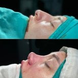 Resultados de rinoplastia antes y después en Büyük Anadolu Hospitals (BAH), cirugía nasal