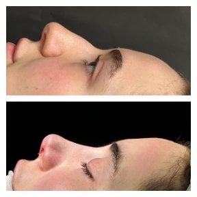 Before and after septoplasty results at Memorial Şişli Hospital, improved nasal profile