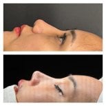 Before and after septoplasty results at Memorial Şişli Hospital, improved nasal profile