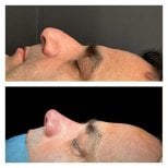 Before and after septoplasty results at Memorial Şişli Hospital, improved nasal profile