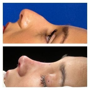 Before and after septoplasty results at Memorial Şişli Hospital, improved nasal profile
