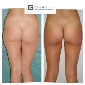 Before and after liposuction results at Clinica Granado Tiagonce, improved body contour