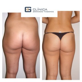Before and after liposuction results at Clinica Granado Tiagonce, improved body contour