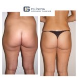 Before and after liposuction results at Clinica Granado Tiagonce, improved body contour