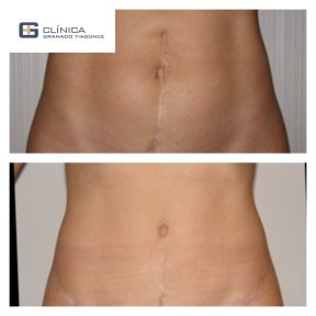 Before and after liposuction results at Clinica Granado Tiagonce, improved abdominal contour