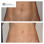 Before and after liposuction results at Clinica Granado Tiagonce, improved abdominal contour