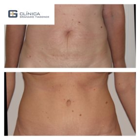 Before and after liposuction results at Clinica Granado Tiagonce, abdomen contour improved