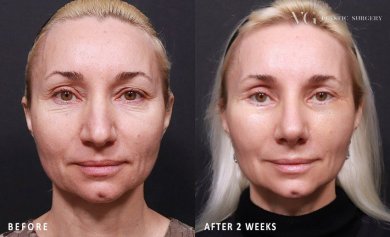 Before and after lower eyelid blepharoplasty results at VG Plastic Surgery, reduced eye bags