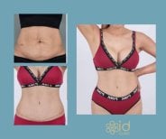 Before and after liposuction results at ID Clinic Bangkok, visible abdominal contour improvement
