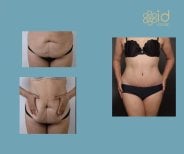 Before and after liposuction results at ID Clinic Bangkok, improved abdominal contour and shape