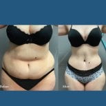 Before and after liposuction results at ID Clinic Bangkok, visible waist contour improvement