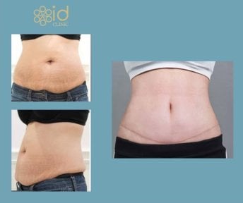 Before and after liposuction results at ID Clinic Bangkok, visible abdominal contour improvement