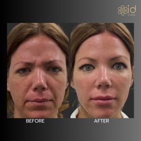Before and after fillers injection at ID Clinic Bangkok, facial rejuvenation and wrinkle reduction result