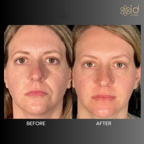 Before and after fillers injection result at ID Clinic Bangkok, facial volume enhancement