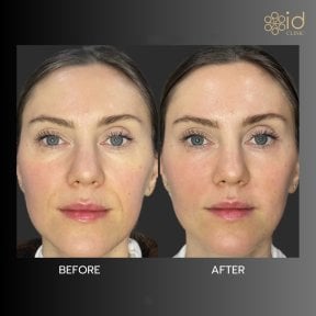 Before and after fillers injection result at ID Clinic Bangkok, facial volume enhancement
