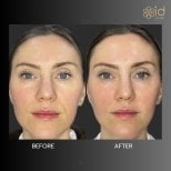 Before and after fillers injection result at ID Clinic Bangkok, facial volume enhancement