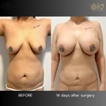 Результаты до и после абдоминопластики и подтяжки груди в ID Clinic Bangkok, 14 дней