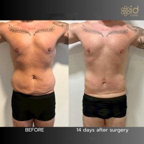 Результати до і після абдомінопластики в ID Clinic Bangkok, плоский живіт за 14 днів