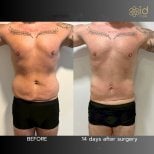 Результати до і після абдомінопластики в ID Clinic Bangkok, плоский живіт за 14 днів