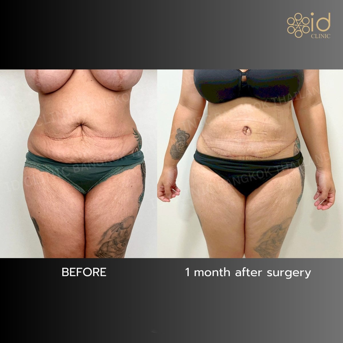 Resultados de abdominoplastia antes y después en ID Clinic Bangkok, mejora del contorno abdominal
