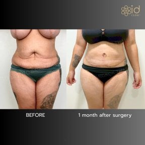 Результаты абдоминопластики до и после в ID Clinic Bangkok, улучшение контура живота