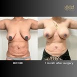 Результаты абдоминопластики до и после в ID Clinic Bangkok, улучшение контура живота