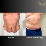 Before and after tummy tuck results at ID Clinic Bangkok, visible abdominal contour improvement