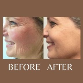 Before and after Morpheus8 skin tightening results at ID Clinic Bangkok, reduced facial wrinkles