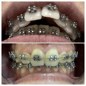 Before and after braces treatment result at Spanderashvili Dental Clinic, teeth alignment improvement