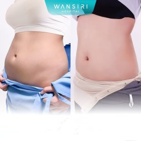 Before and after liposuction results at Wansiri Hospital, visible abdominal contour improvement