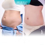 Before and after liposuction results at Wansiri Hospital, visible abdominal contour improvement