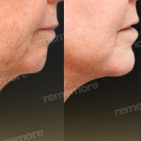 Before and after chin implant results at Memorial Şişli Hospital, improved chin contour
