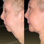 Before and after chin implant results at Memorial Şişli Hospital, improved chin profile