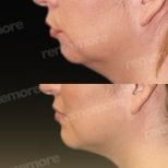 Before and after chin implant results at Memorial Şişli Hospital, improved chin contour
