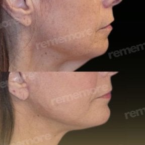 Before and after chin implant results at Memorial Şişli Hospital, improved chin contour