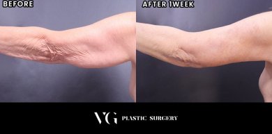 Before and after arm lift (brachioplasty) results at VG Plastic Surgery, improved arm contour