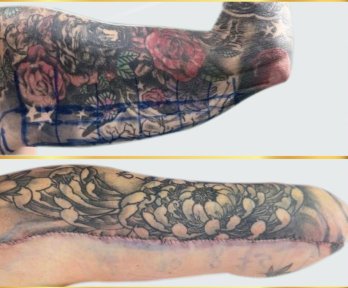 Before and after arm lift (brachioplasty) results at DGB Clinic, improved arm contour