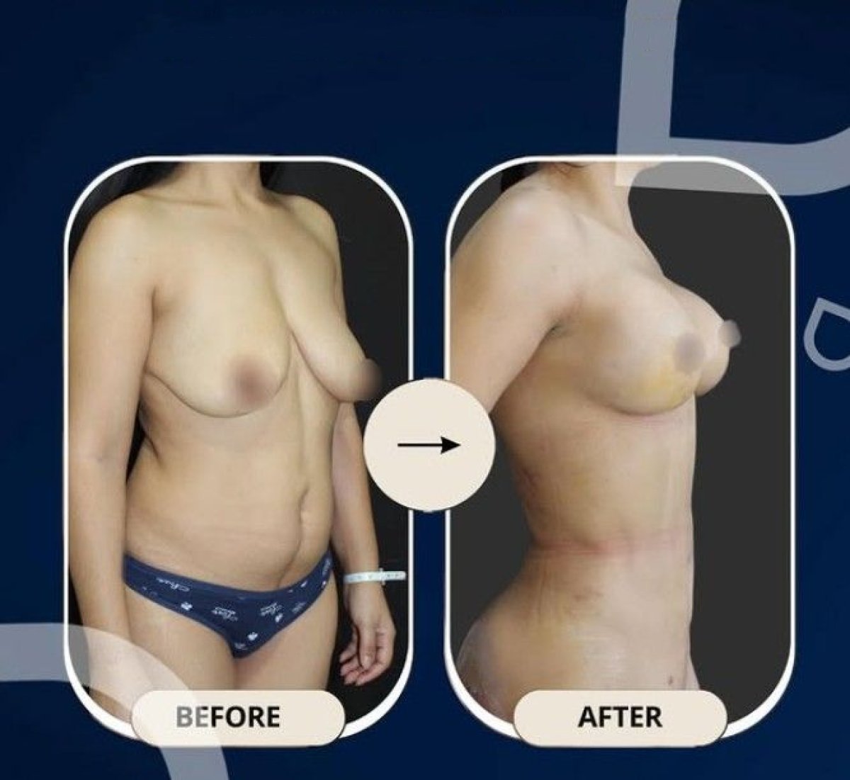 Resultados de lifting de senos antes y después en TWT Health Clinic, mejor contorno mamario