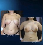 نتائج شد الثدي قبل وبعد في عيادة TWT Health Clinic، تحسين شكل ورفع الثدي