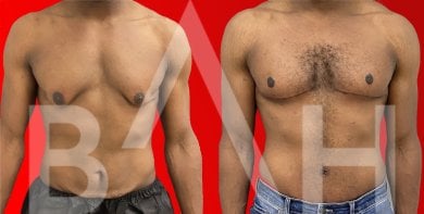 Before and after gynecomastia surgery results at Büyük Anadolu Hospitals (BAH), male chest contour