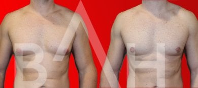 Before and after gynecomastia surgery results at Büyük Anadolu Hospitals (BAH), male chest contour