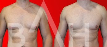 Before and after gynecomastia surgery results at Büyük Anadolu Hospitals (BAH), male chest contour