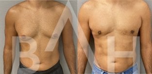 Before and after gynecomastia surgery results at Büyük Anadolu Hospitals (BAH), male chest contour