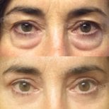 Before and after blepharoplasty results at Memorial Bahçelievler Hospital, eyelid correction