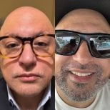 Resultados antes y después de trasplante de barba en Estemarley – barba más densa