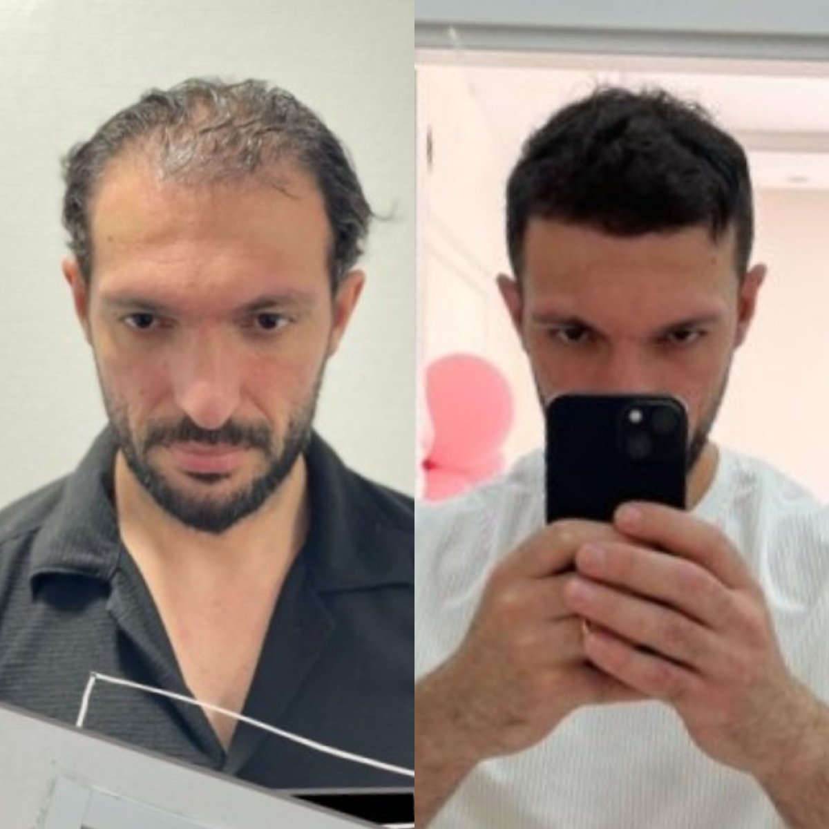 Vorher-nachher-Ergebnis Haartransplantation bei Estemarley – volle, erneuerte Haarlinie