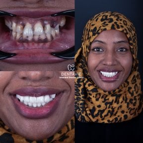 Before and after dental implant results at Dentavie Istanbul Dental Clinic, improved smile